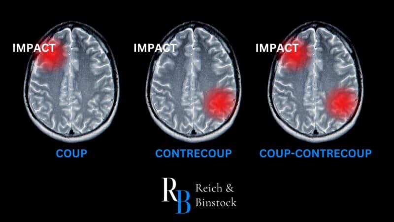 what-is-a-coup-contrecoup-brain-injury-brain-injury-attorneys