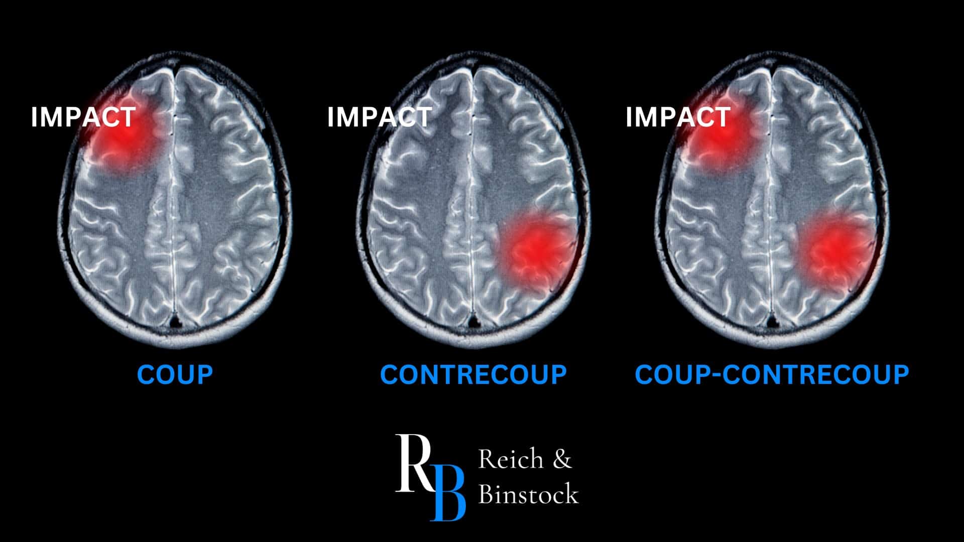 What Is A Coup Contrecoup Brain Injury Brain Injury Attorneys